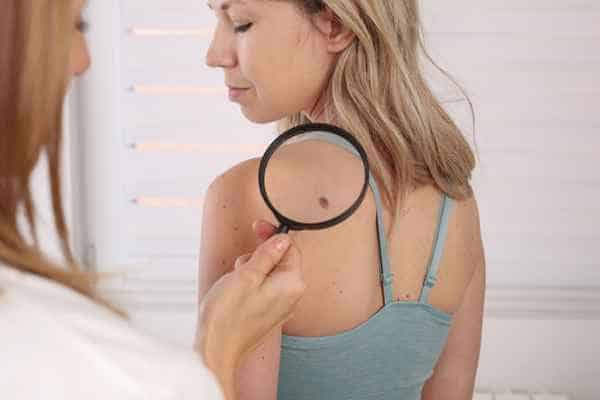 What Are Traditional Skin Lesion Removal Methods Telford?