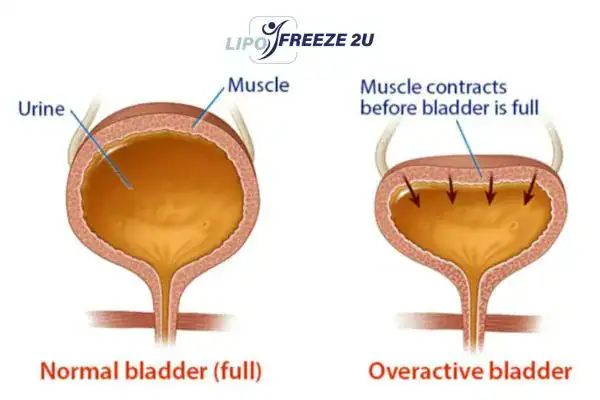 diagram of overactive bladder treatment Telford