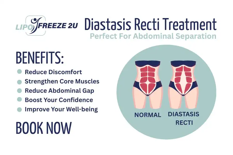 Benefits of body toning treatment Telford for Diastasis recti