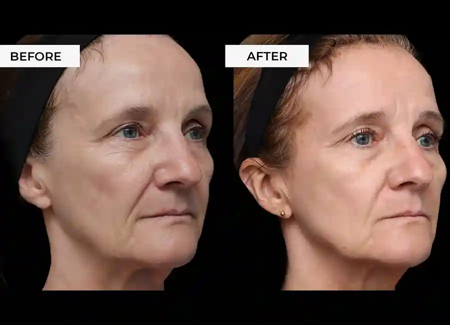 How Many RF Microneedling Sessions Will You Need to See a Difference Telford?